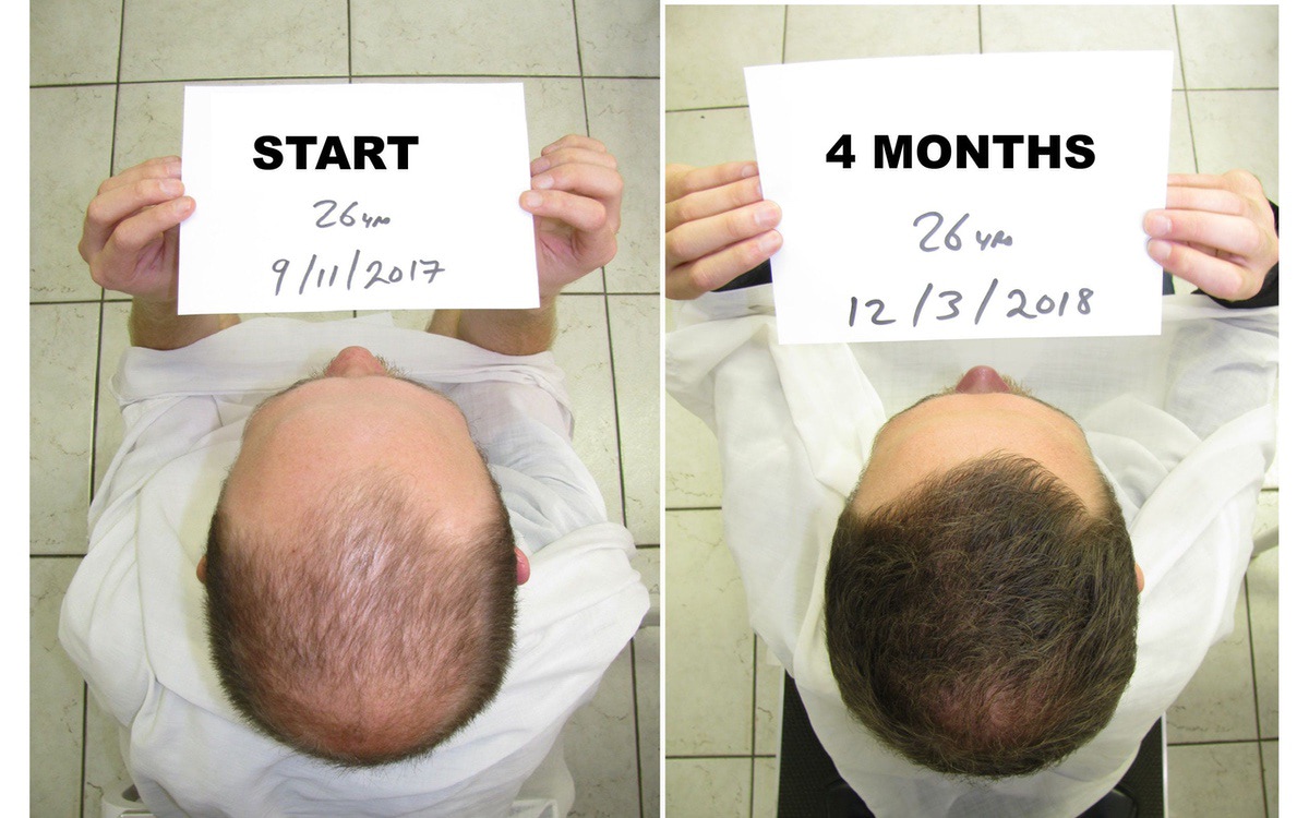 Male Pattern Baldness