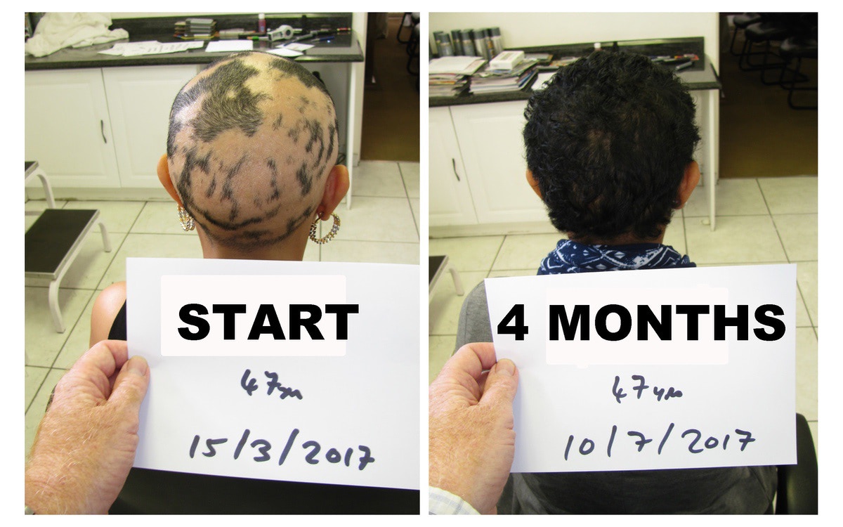 Alopecia Areata