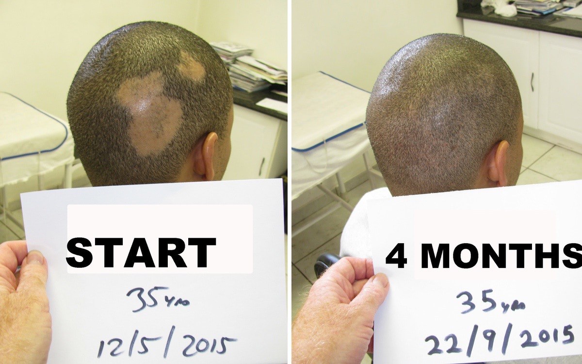 Alopecia Areata